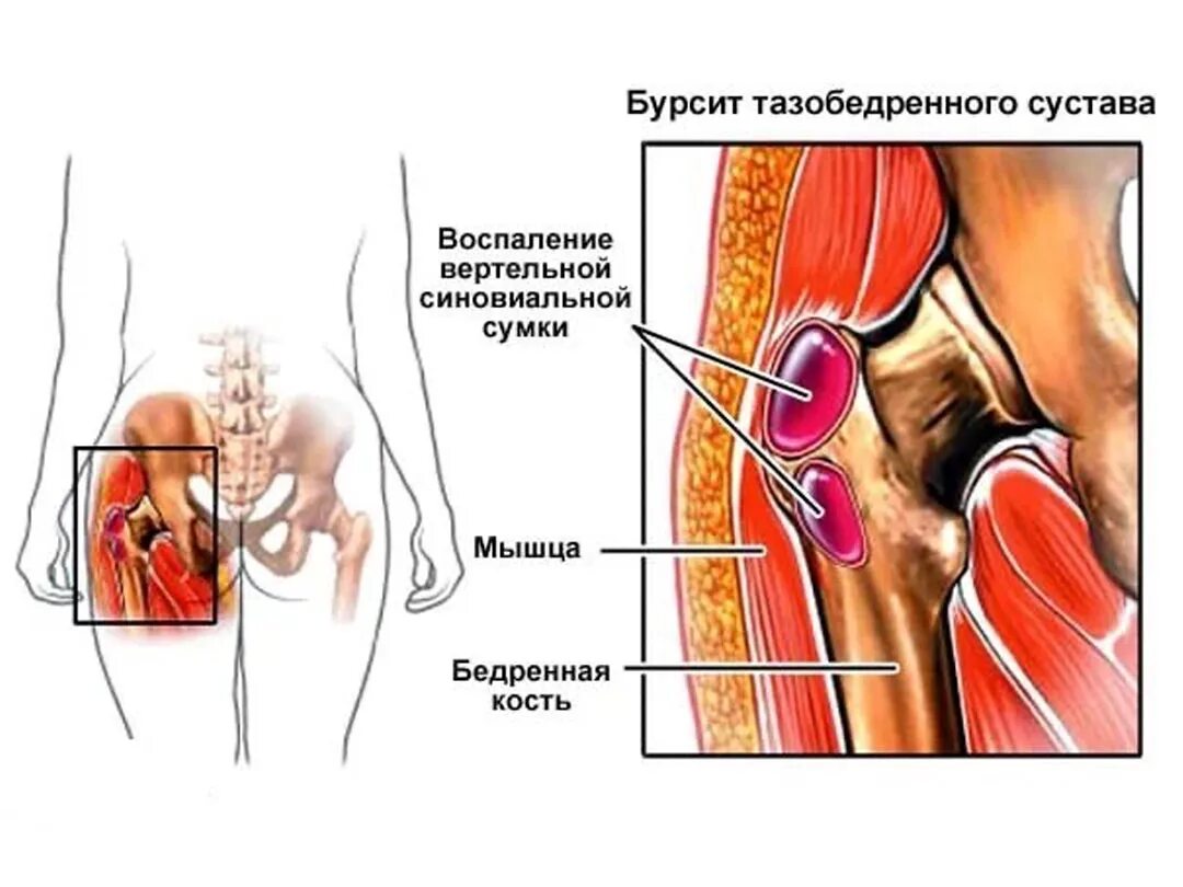 К какому врачу обращаться с тазобедренным суставом. Воспаление околосуставной сумки тазобедренного сустава. Бурсит трохантерит тазобедренного сустава. Вертельный бурсит тазобедренного сустава. Бурсит вертельной сумки тазобедренного сустава.