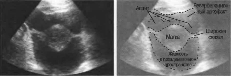 УЗИ малый таз жидкость в позадиматочном пространстве. Позадиматочное пространство свободная жидкость УЗИ. Жидкость в дугласовом пространстве на УЗИ. Дугласово пространство жидкость на УЗИ.