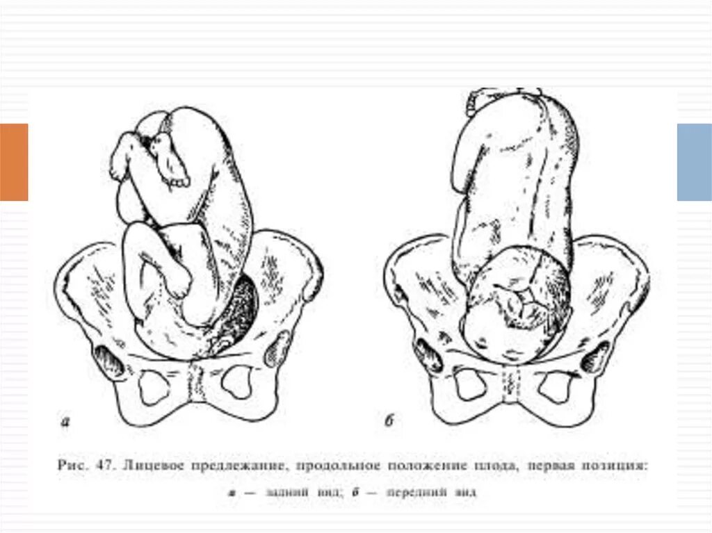 Правильное предлежание. Продольное головное предлежание 2 позиция. Положение плода продольное предлежание головное. Первая позиция передний вид. Положение предлежание вид и позиция плода.