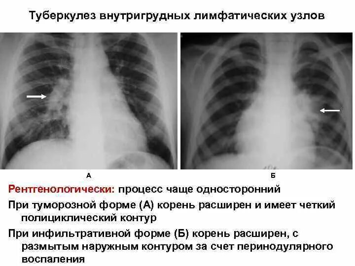 Бронхоаденит это