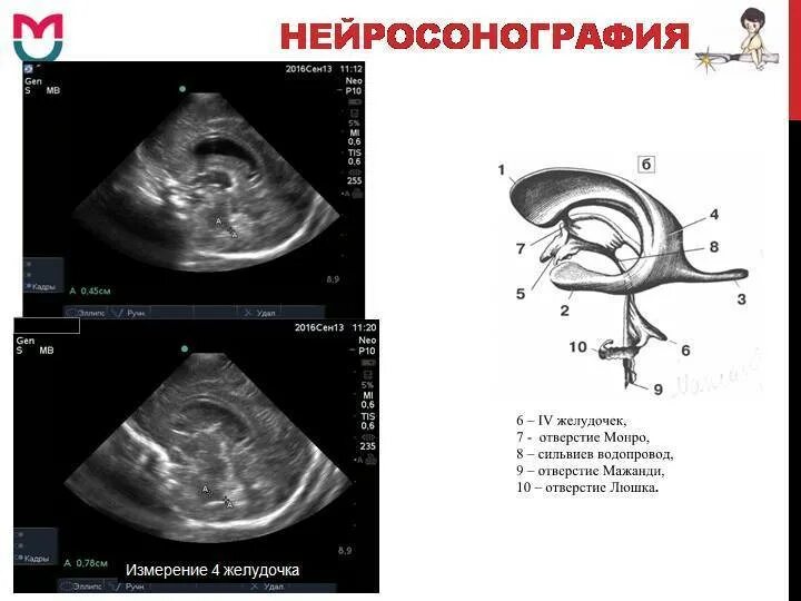3 желудочек мозга на мрт. Таблица размеров желудочков головного мозга у детей норма. Нейросонография головного мозга грудничка норма. 3 желудочек головного мозга размеры норма. Узи головного мозга у грудничка норма в 3 месяца таблица.