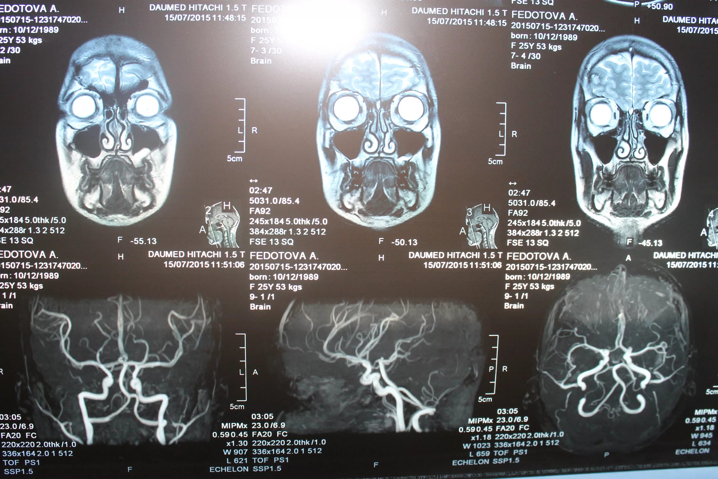 Ангиома правой лобной доли. Венозная ангиома лобной доли головного мозга. Венозная ангиома правой лобной доли что это такое на мрт.