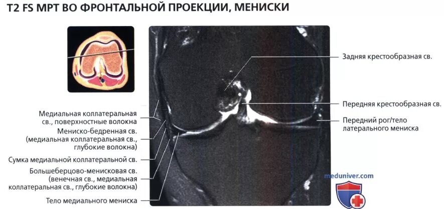 Разрыв мениска код. Повреждение мениска коленного сустава мрт. Мышцы коленного сустава мрт анатомия. Анатомия менисков коленного сустава мрт.