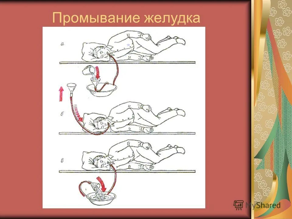 Промывание желудка схема. Промывание желудка. Как делается промывание. Промывание желудка пациенту. Промывание желудка водой.