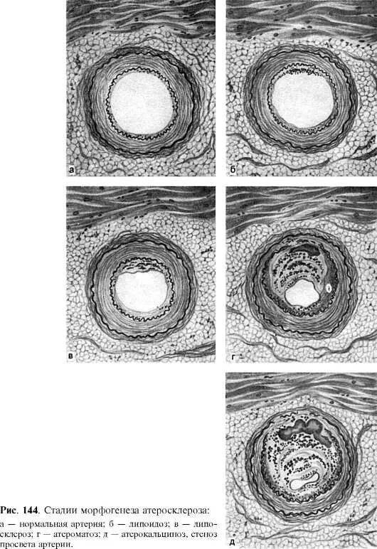степени атеросклероза патанатомия. патогенез атеросклероза патофизиология. стадии атеросклероза патанатомия. стадии атеросклероза патанатомия. степени атеросклероза патанатомия.