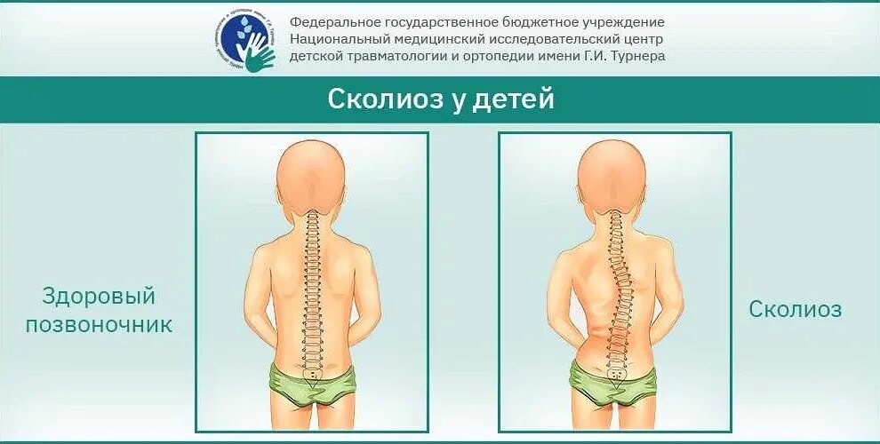 Сколиоз у ребенка какой врач. Искривление позвоночника у детей. сколиоз позвоночника у детей причины. сколиоз 1 степени у подростка.