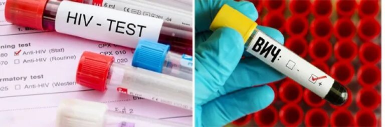 Кровь на вич 1 2. Диагностика ВИЧ ИФА. Диагностика ВИЧ метод ИФА. ИФА тест на ВИЧ. ИФА на ВИЧ положительный.