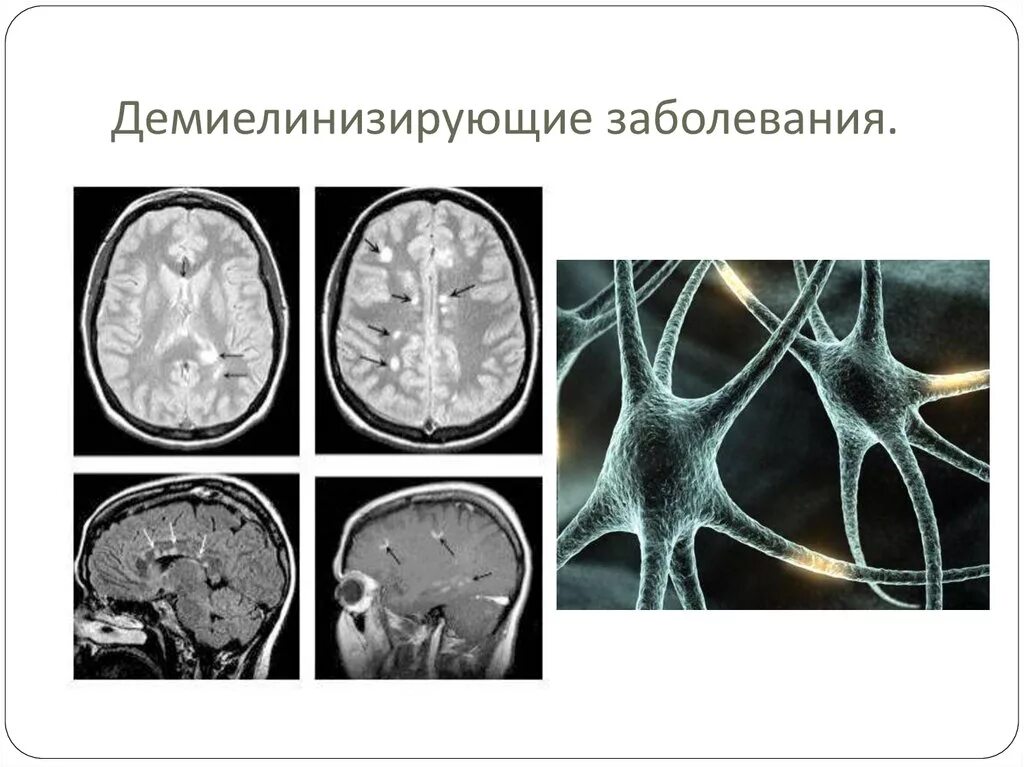 Признаки демиелинизирующего поражения. Демиелинизация нервных волокон гистология. Демиелинизирующие заболевания головного мозга. Демиелинизирующие заболевания неврология классификация. Демиелинизация головного мозга мрт.