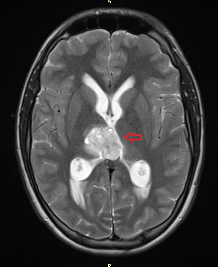 Опухоли желудочков. Герминома головного мозга мрт. Герминома шишковидной железы кт. Бифокальная герминома.