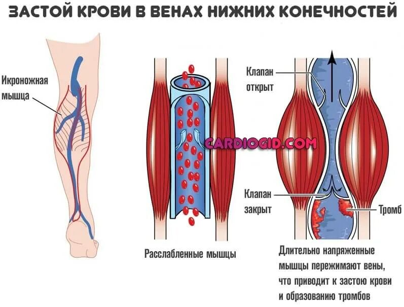 Сильно болит вена. Образования тромбов в нижних конечностях (тромбоз глубоких вен). Тромбоз мышечных вен голени. Тромбоз сосудов нижних конечностей бедра. Варикозное расширение вен (ВРВ) нижних конечностей.