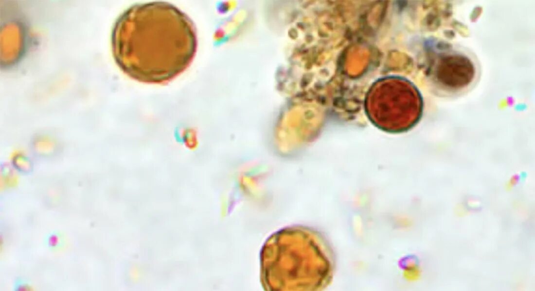 Blastocystis Hominis. Простейшие в кале лечение