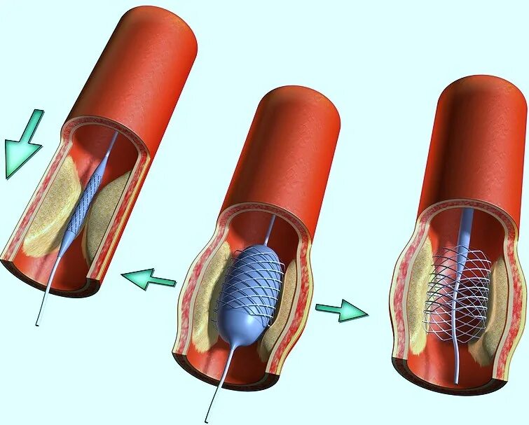 3 стента. Баллонная коронарная ангиопластика. Стентирование коронарных артерий. ТРАНСЛЮМИНАЛЬНАЯ ангиопластика сосудов. Стентирование сосудов коронарных артерий.