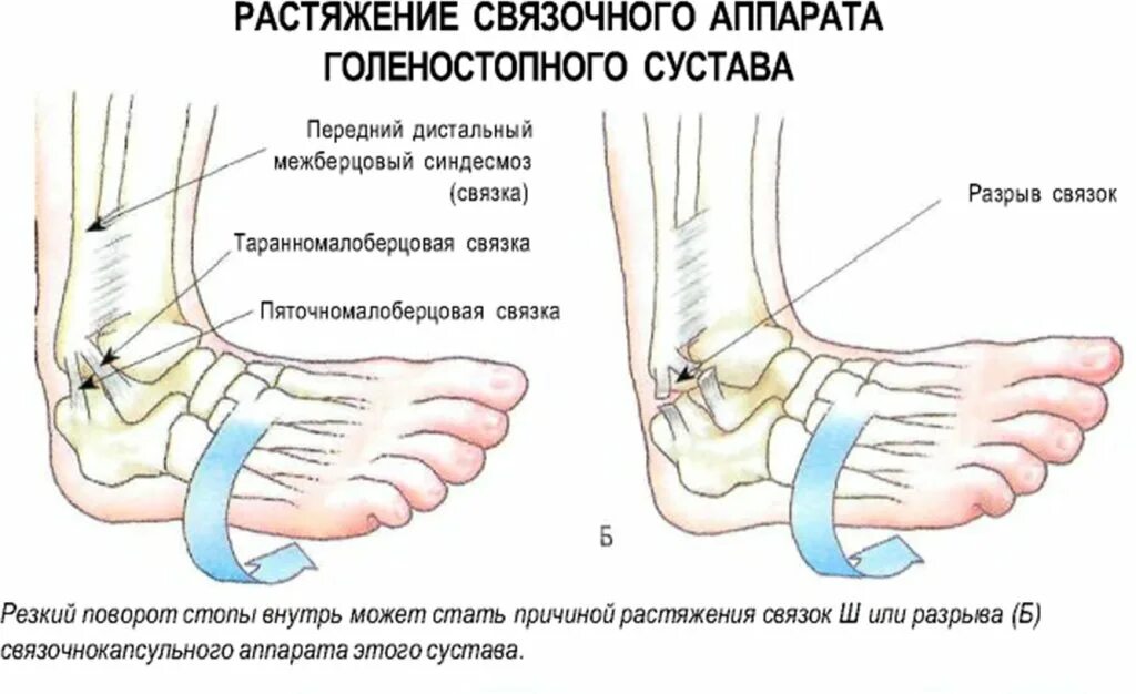 Капсульно-связочный аппарат голеностопного сустава. Травма стопы капсульно связочного аппарата. Повреждение капсульно-связочного аппарата левого . Сустава. Разрыв капсульно-связочный аппарат стопы.