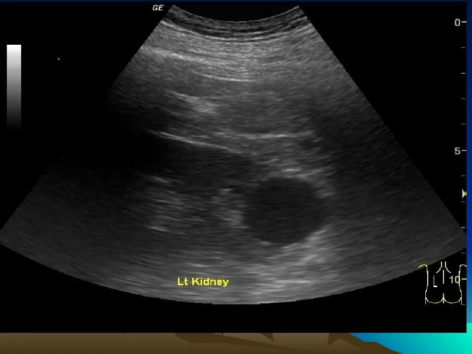 Киста паренхимы почки УЗИ. Истончение паренхимы почек на УЗИ. Снимок УЗИ здоровой почки. Как выглядит почка на УЗИ. Узи почек на голодный