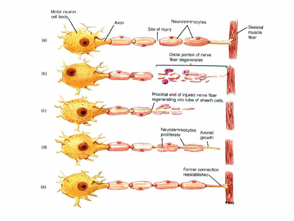 Регенерация нервного волокна схема. Регенерация нервных волокон после повреждения. Дегенерация периферического нерва. Регенерация нейронов гистология схема.