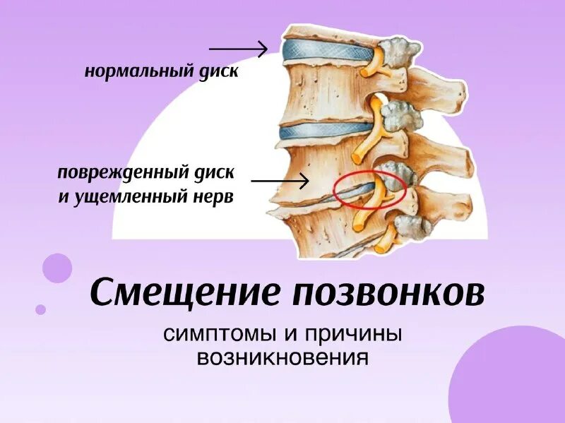 смещение шейного позвонка атланта. смещение 2 позвонка шейного отдела симптомы. спондилолистез l5 позвонка поясницы. признаки смещения позвонков. признаки смещения позвонков.