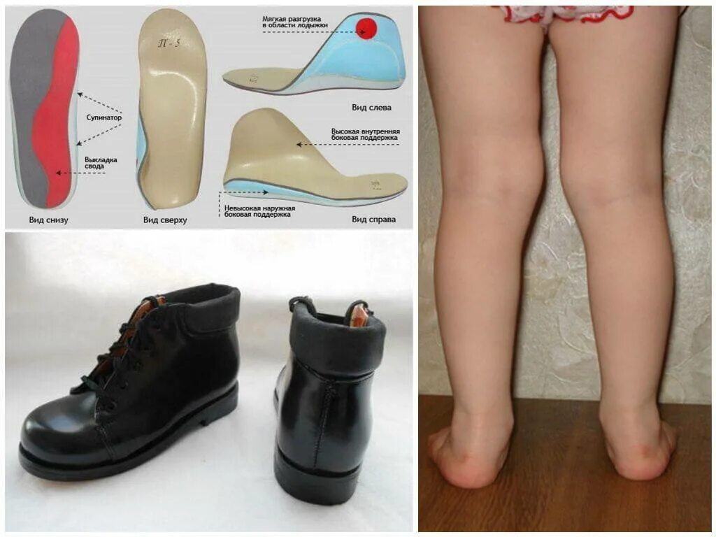Вальгус какую обувь. Ортопедическая обувь для детей при плосковальгусной деформации стоп. Ортопедические стельки при вальгусной деформации. Ортопедические стельки Варус вальгус. Плосковальгусная деформация стоп стельки.