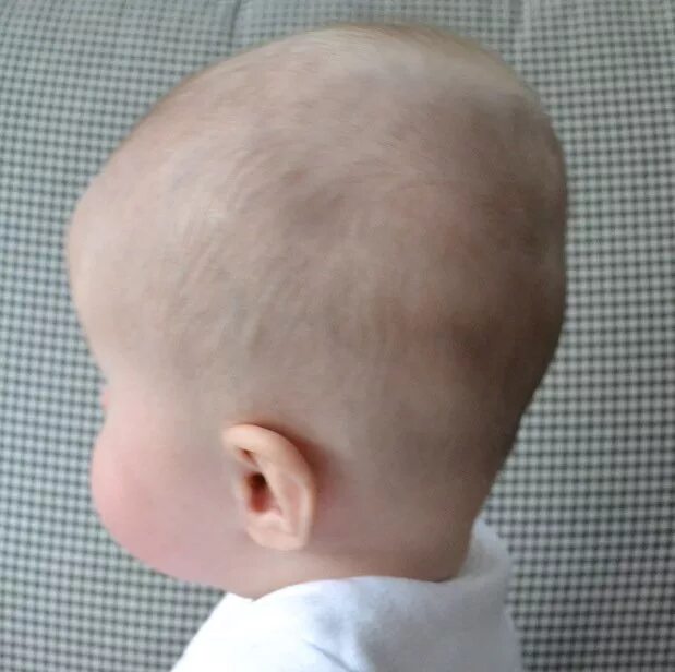 Выступающий затылок. Рахит череп новорожденного. Рахит форма головы грудничка.