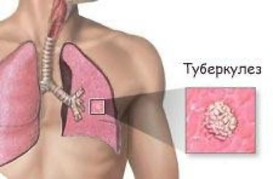 Лечится ли туберкулез у взрослых. Лечится ли туберкулез у взрослых