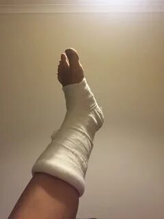Фото девушек в гипсе нога