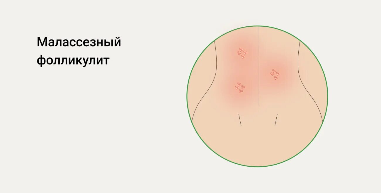 Фолликулит в носу - Фотобанк PhotoSreda.ru
