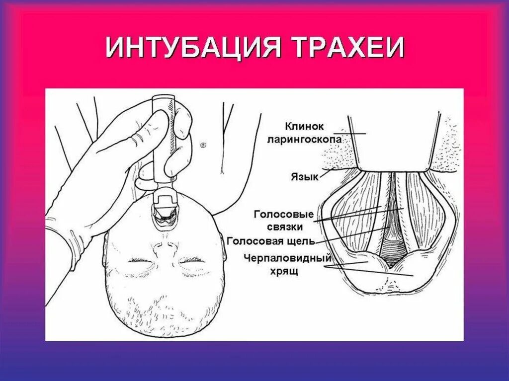 Интубация трахеи у новорожденных алгоритм. Интубация трахеи у новорожденных. Техника интубации трахеи новорожденному. Интубация трахеи алгоритм новорожденного. Осложнения трахеи