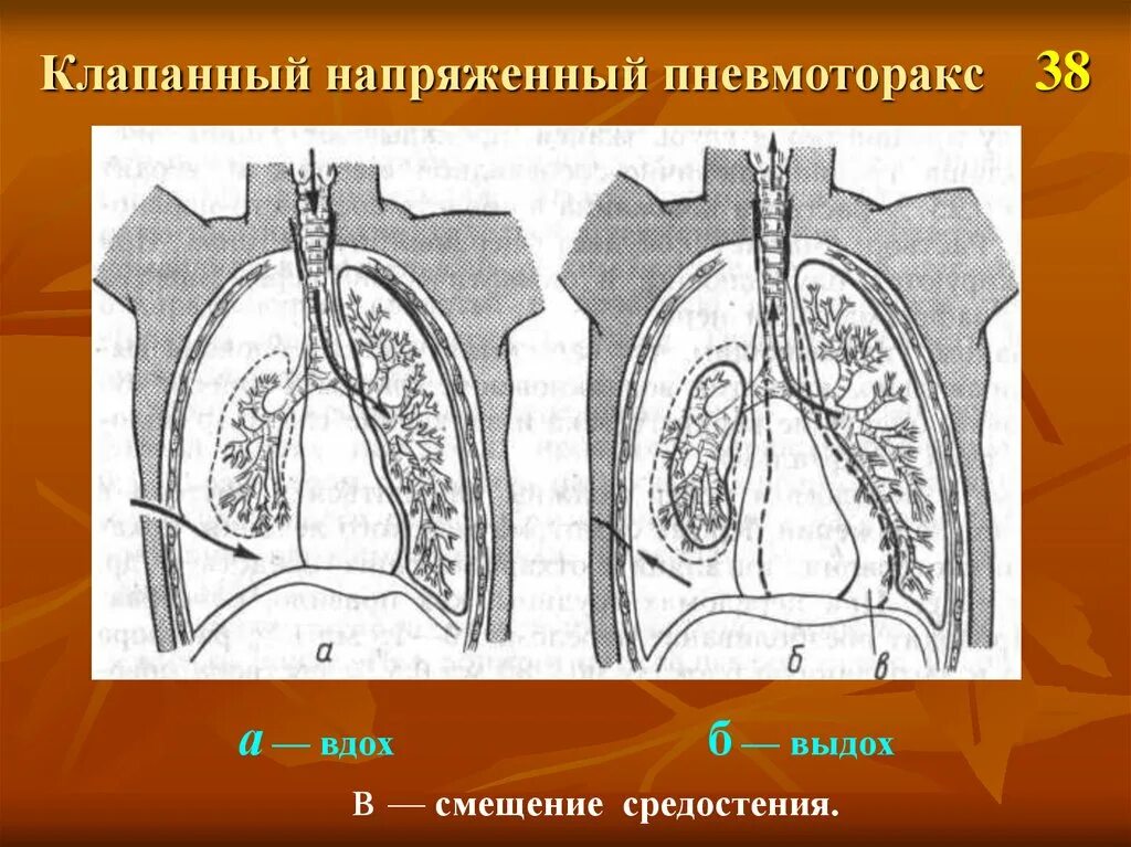 Напряженный пневмоторакс помощь. Наружный клапанный пневмоторакс. Наружный и внутренний пневмоторакс. Открытый и клапанный пневмоторакс. Внутренний клапанный пневмоторакс.