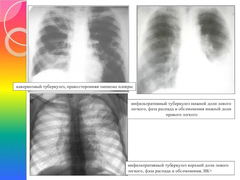Инфильтративный туберкулез легких фаза распада рентгенограмма. Инфильтративный туберкулез в фазе инфильтрации. Фаза обсеменения при туберкулезе. Туберкулез в фазе инфильтрации и распада. Инфильтративный туберкулез в фазе распада.