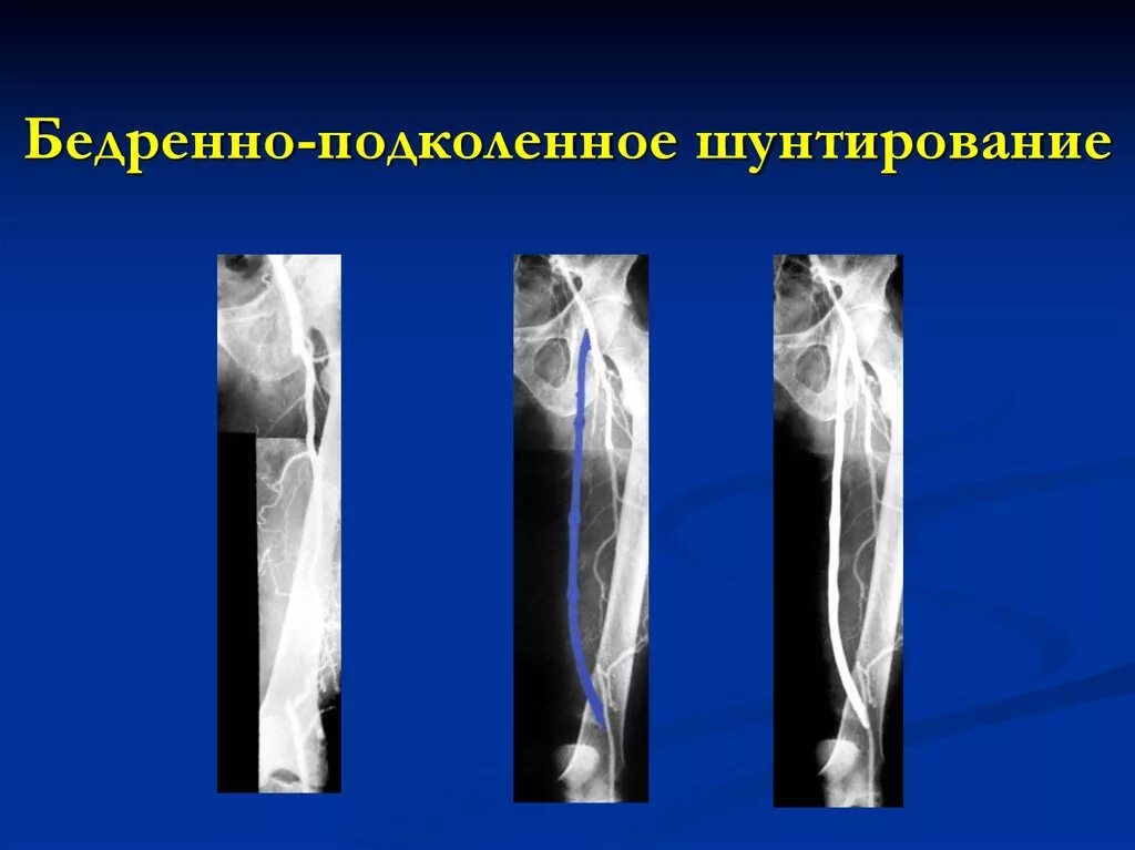 Состояние после бедренно. Бедренно-тибиальный шунт. подколенно-тибиальное шунтирование. шунтирование реверсированной аутовеной бедренно-подколенное. бедренно-подколенное шунтирование.