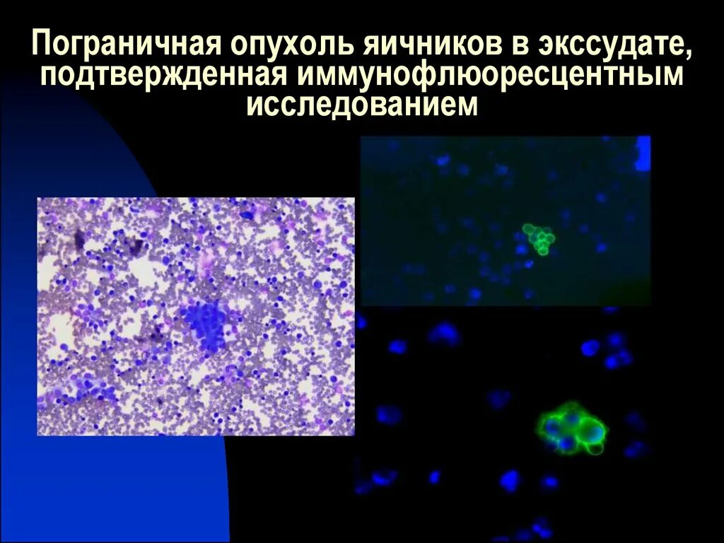 Пограничная опухоль яичника цитология. Пограничные новообразования это. Микроскопия выпотных жидкостей. Пограничные опухоли яичников классификация. Серозная пограничная опухоль