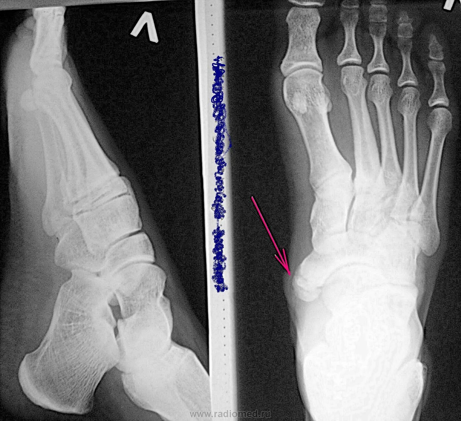 Ладьевидная кость стопы перелом. Сесамовидная кость стопы перелом. Перелом плюсневой кости стопы рентген. Усталостный перелом ладьевидной кости. Перелом подошвы