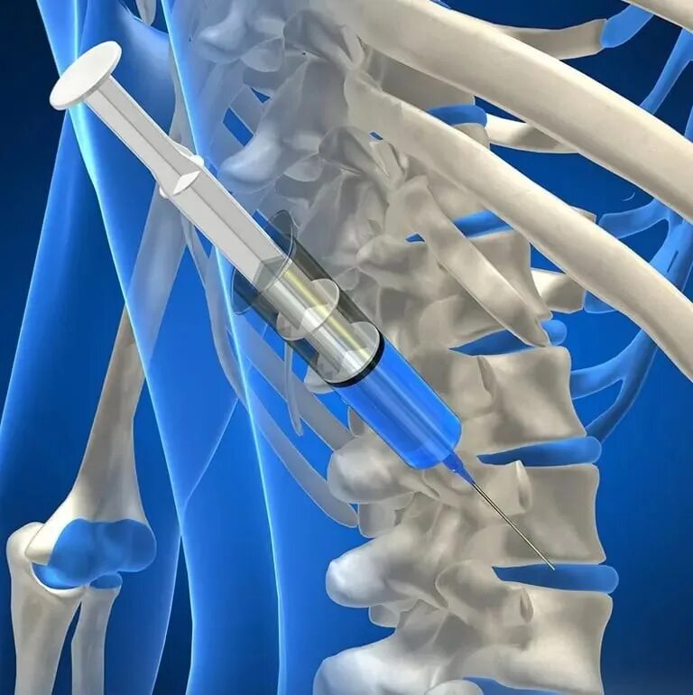 Блокада позвоночника что это такое. Медикаменты для блокады позвоночника. Медикаментозная блокада.