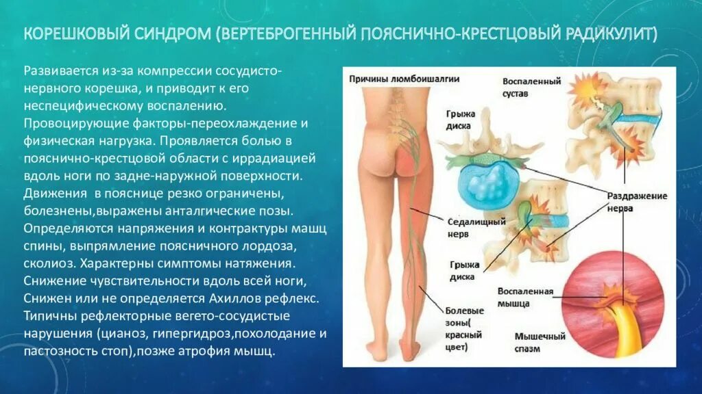 Радикулит симптомы у мужчин лечение. Корешковый синдром. Корешковый синдром симптомы. Корешковый синдром поясничного отдела. Клинические проявления корешкового синдрома.