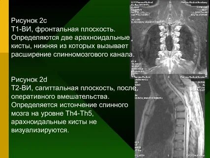 Размеры кисты позвоночника