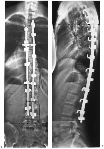 Котреля-Дюбуссе. Титановые пластины в позвоночнике. Операция Котреля-Дюбуссе. Операция на позвоночник при сколиозе. Реабилитация после операции на позвоночнике с металлоконструкций