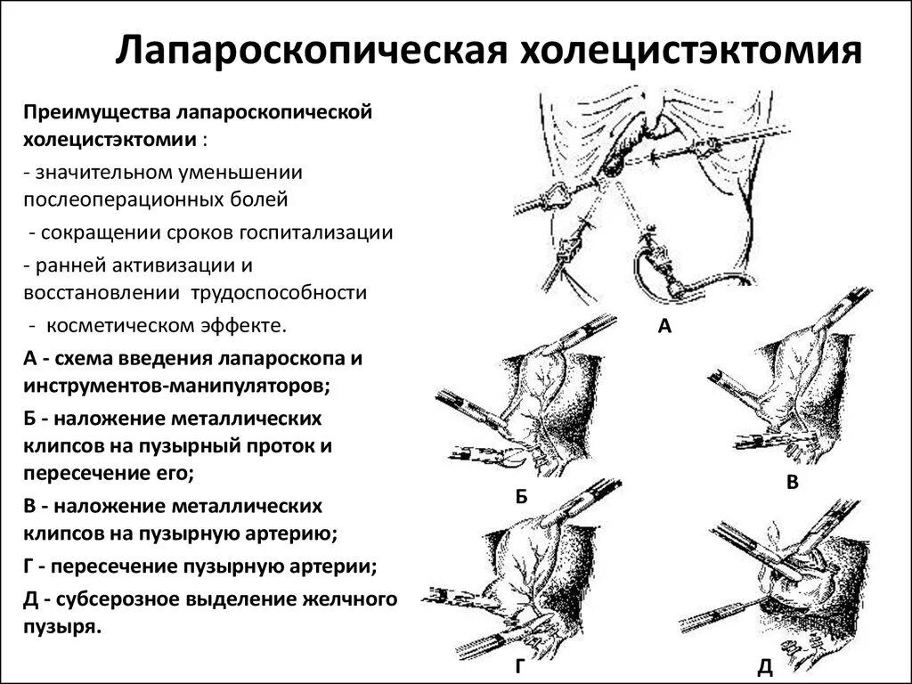 Этапы холецистэктомии. Лапароскопическая холецистэктомия (i категории сложности). Лапароскопическая холецистэктомия этапы операции. Холецистэктомия лапаротомия ход операции. Лапароскопия холецистэктомия ход операции.