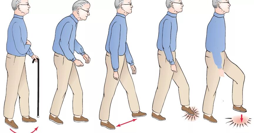 Нарушение равновесия и координации движений это. Клинические проявления болезни паркинсона. Анимация ходьбы гиф. Нарушение координации. Походка больного паркинсоном.
