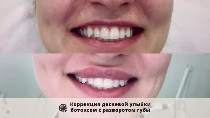 десневая улыбка ботокс. хейлопластика десневая улыбка. исправление десневой улыбки. гингивопластика десневая улыбка. десневая улыбка коррекция ботоксом.