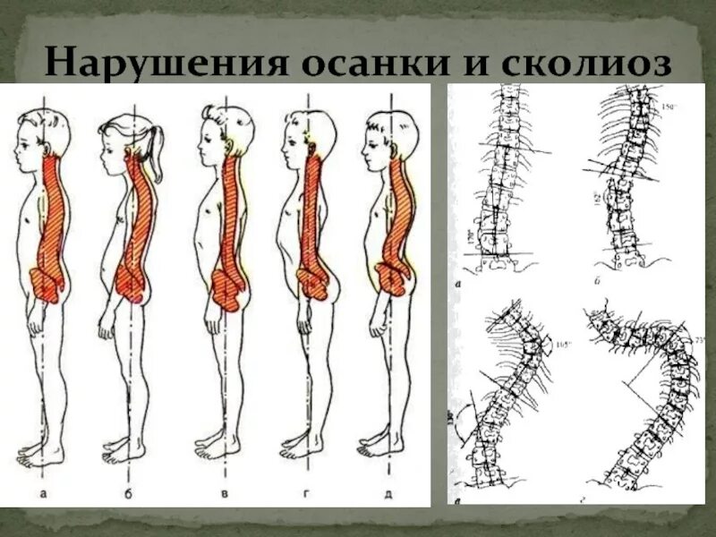 Искривление осанки у детей. Сколиотическое нарушение осанки. нарушениях осанки, сколиозах и плоскостопии. осанка и искривление позвоночника. первая степень нарушения осанки.