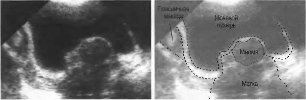 Расположение матки и мочевого пузыря. Эндометриоз мочевого пузыря на УЗИ. Субмукозная миома матки УЗИ.
