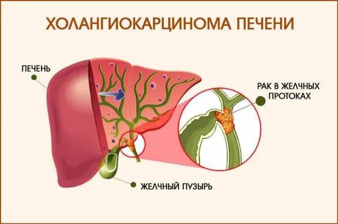 Метастазы в желчном
