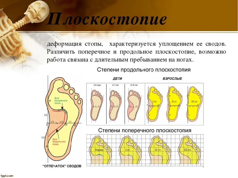 Изменения свода стопы. Поперечное плоскостопие отпечаток стопы. продольное плоскостопие плантография. продольное плоскостопие деформация стопы. продольный свод стопы плоскостопие.