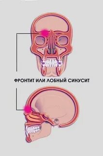 Воспаление лобного