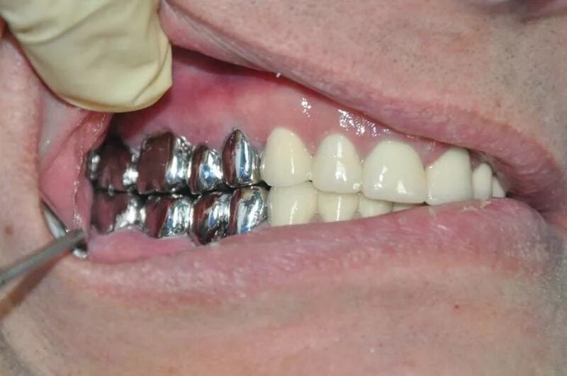 Штампованные коронки на зубы. Металлическая коронка. Металлическая коронка на зуб. Металлические зубные коронки. Металлический мостовидный протез.