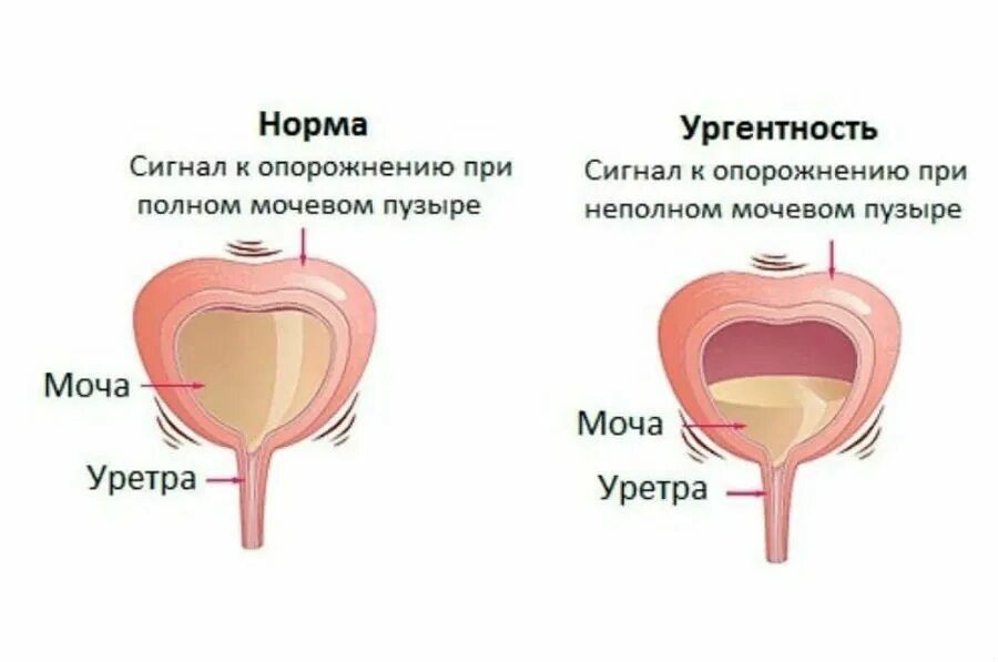 Неполное мочеиспускание. Причины ургентного недержания мочи у женщин. Мочевой пузырь недержание. Опорожнение мочевого пузыря. Опорожнить мочевой пузырь.