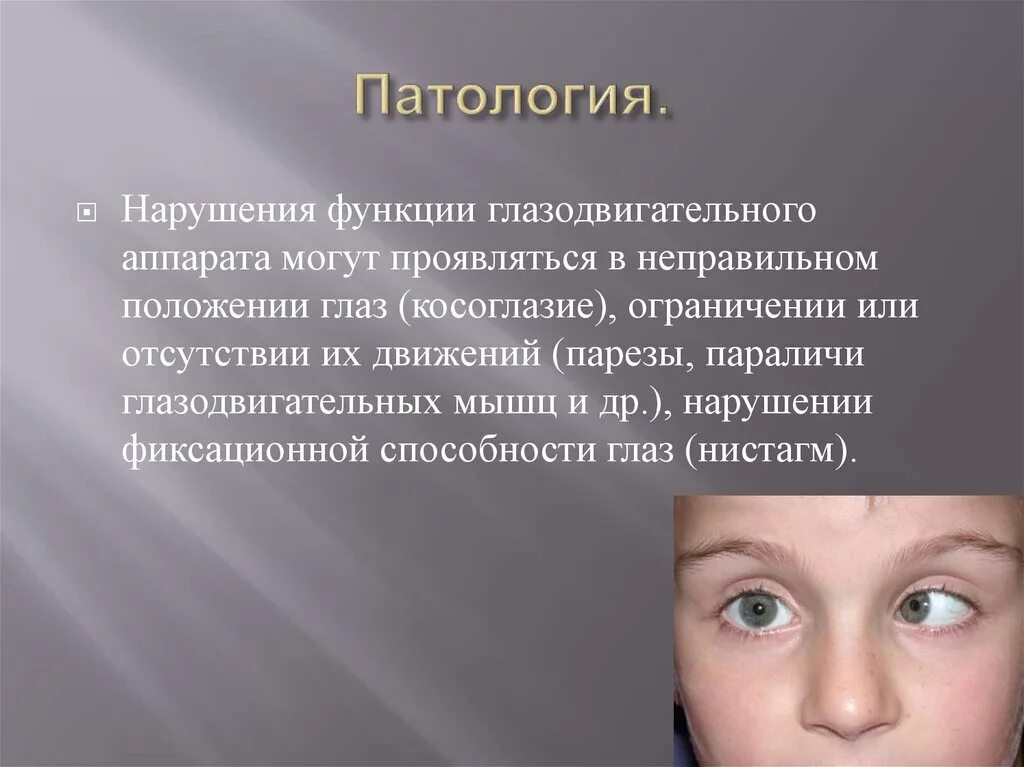 Как понять патологию. Заболевания глазодвигательного аппарата. Патология глазодвигательного аппарата глаза. Классификация нарушений глазодвигательного аппарата.