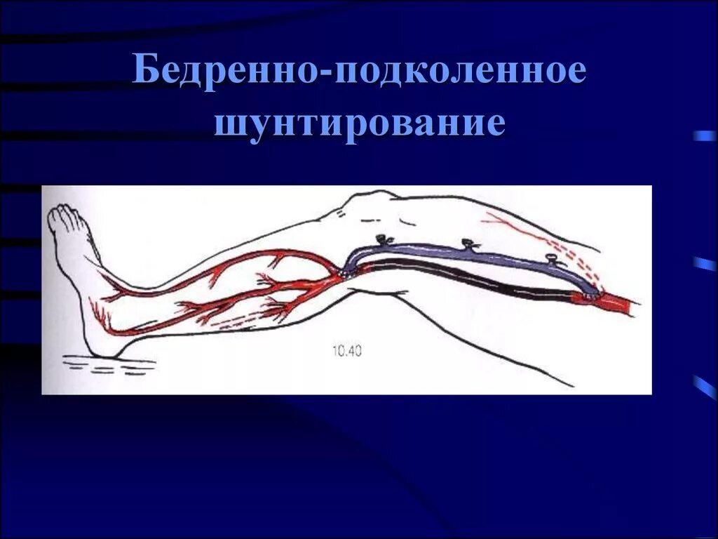 Шунтирование артерий нижних конечностей. Шунтирование реверсированной аутовеной бедренно-подколенное. Бедренно тибиальный шунт. Шунт бедренной артерии. Бедренно-переднетибиальное шунтирование.