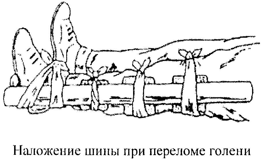 Перелом голени транспортировка. Накладывание шины при переломе голени. Шина при переломе костей голени. Наложить шину при переломе голени.