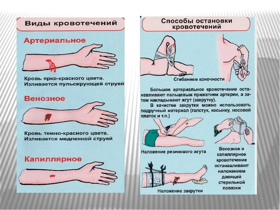 Какие способы остановки кровотечения наиболее эффективны. Способы остановки кровотечений артериальное венозное капиллярное. Методы остановки крови при артериальном кровотечении. Виды РАН, виды кровотечения и способы остановки кровотечения. Способы остановки артериального и венозного кровотечения.