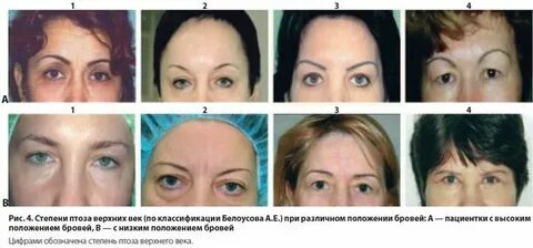 Птоз верхнего века степени